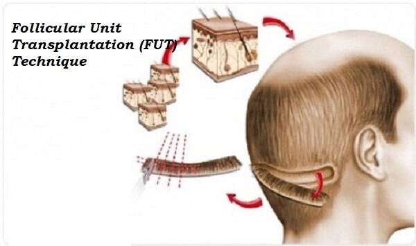 Transplant de par prin metoda FUT