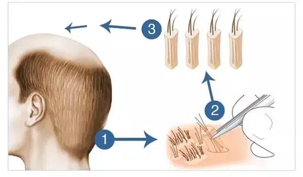 Implant de par metoda FUE